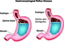 Диета при рефлюкс-эзофагите